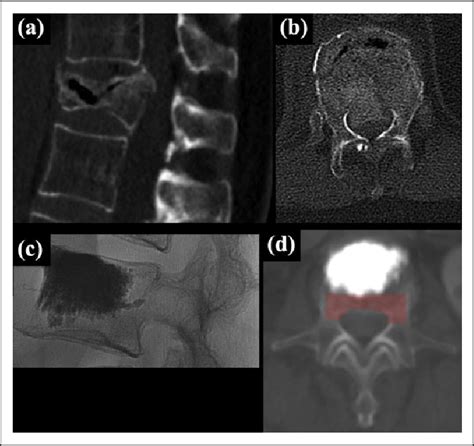 Osteoporotic Vertebral Fracture