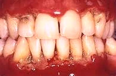 Trench Mouth - Symptoms, Causes, Pictures, Treatment