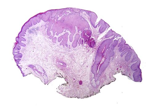 HPV Driven Anal Neoplasia Review And Recent Developments Pathology
