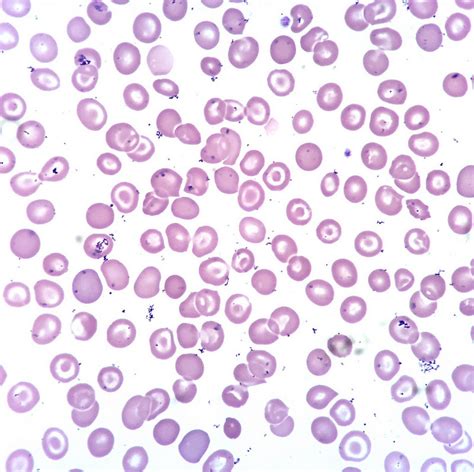 Red Blood Cell Inclusions