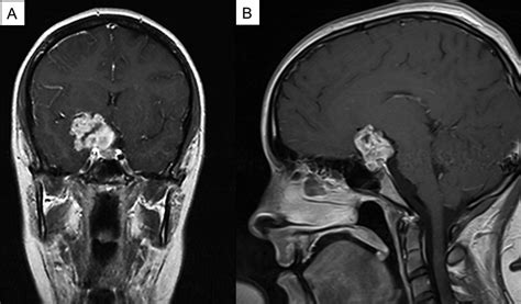 Chondrosarcoma Mri