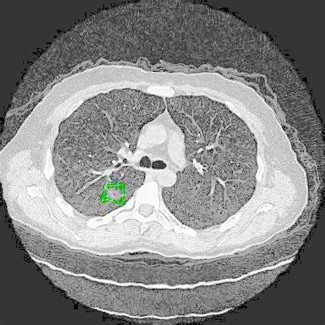 Lung Cancer NormAug Training Instance Segmentation Dataset V1 2023 07