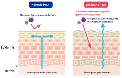 Neurodermitis ALLERGIKA Ihr Experte für gesunde Haut und