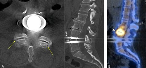 Adjacent Segment Disease A 67 Year Old Woman Presenting With Low Back Download Scientific