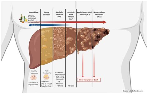 Cells Free Full Text Key Signaling In Alcohol Associated Liver