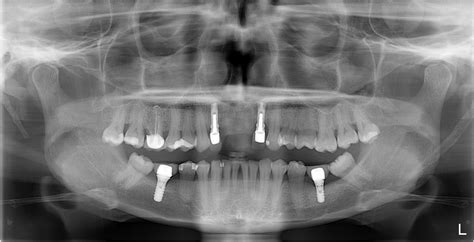 Implant Fixed Bridge Gallery — Texas Dental Solutions