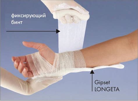 Гипсовая лангета при переломе лучевой кости