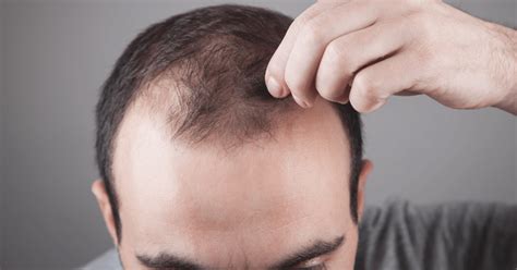 androgenetic alopecia  treatments  home remedies