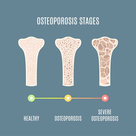 Exercise For The Management Of Osteoporosis Physiox