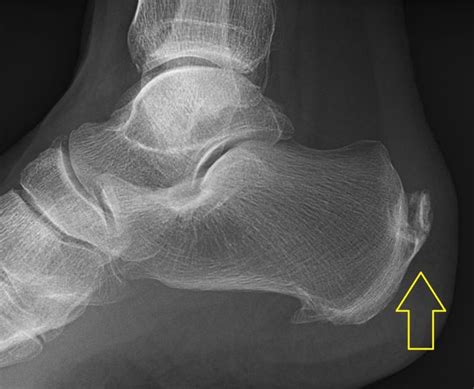 calcific bursitis | Ric Size