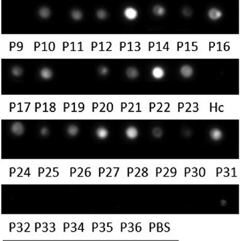 Urine Antigen Detection By Hcp100 Dot Blot Assay P1 P23 Are Urine