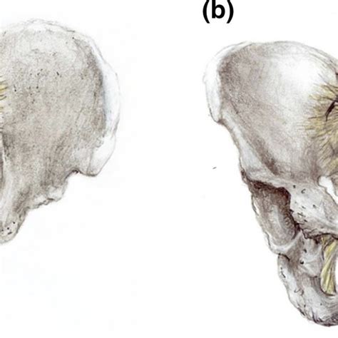 Lateral Compression Type 1 Lc1 Pelvic Ring Injuries A Spectrum Of Fracture Types And