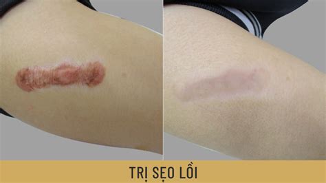 Một số vấn đề đặc biệt của điều trị sẹo lồi