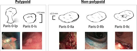 Managing Risk Of Dysplasia And Colorectal Cancer In Inflammatory Bowel