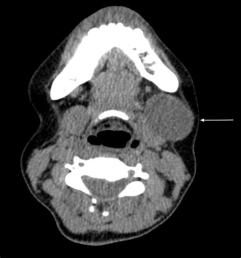 An Epidermoid Cyst Of The Submandibular Space Journal Of Case Reports