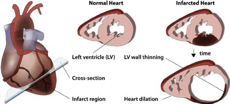 Myocardial infarction (MI) causes severe damage and adverse remodeling ...