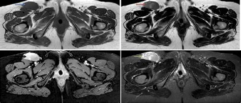 Figure 6 From Castlemans Disease Beyond The Differential Diagnostic