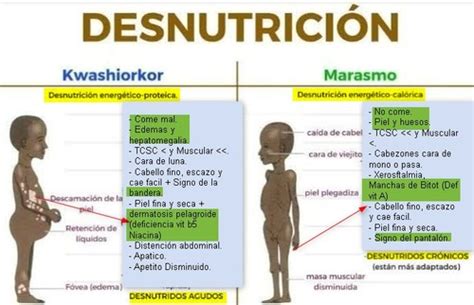 DESNUTRICIÓN Quizlet