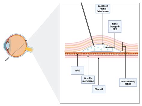 Subretinal Injection Techniques For Retinal Disease Encyclopedia MDPI