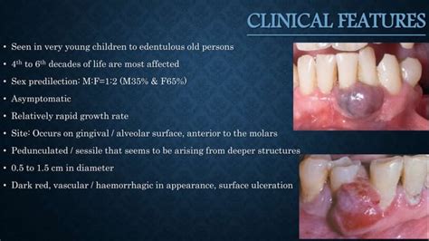 Peripheral Giant Cell Granuloma Of Oral Cavity PPT