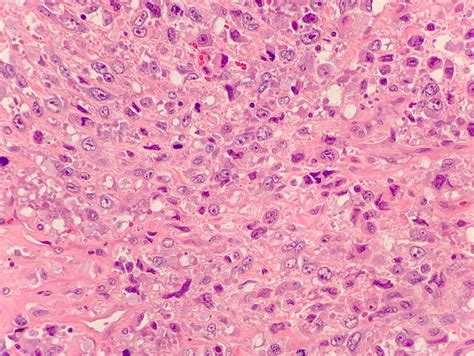 Pathology Outlines Dedifferentiated Chondrosarcoma