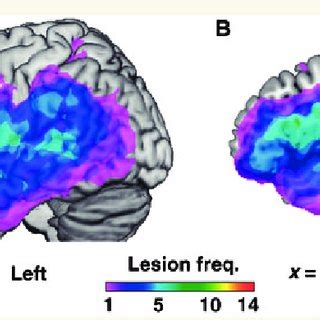 (PDF) Reorganization of syntactic processing following left-hemisphere ...