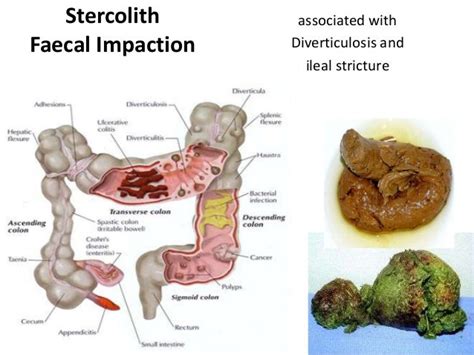 Pathopyshiology Of Intestinal Obstruction Chirantan Mandal Medical Co