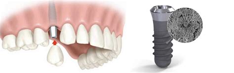 Implante Dentario Carga Imediata Kb Implart