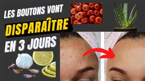 Comment éliminer les boutons du visage rapidement en 3 jours 4Astuces