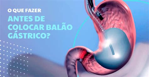 Como Se Preparar Para Colocar O Balão Gástrico Clínica Edt