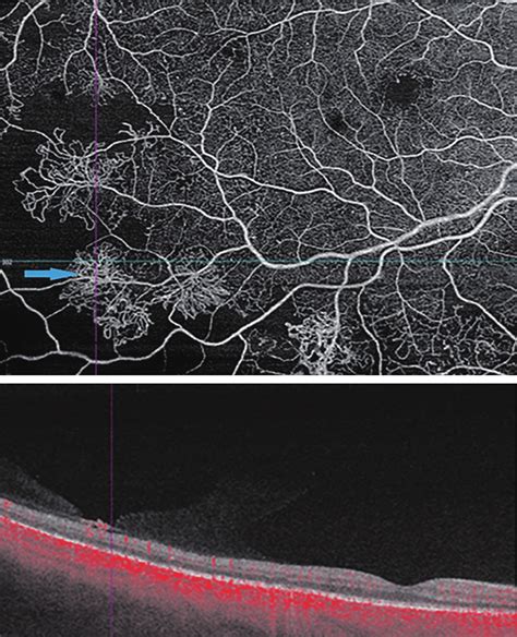 A Mm Mm En Face Octa Scan Showing Retinal Neovascularization In