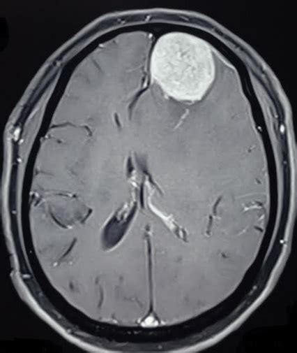 Subfalcine Herniation Treatment And Management Point Of Care