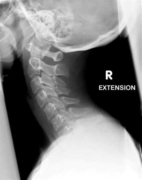 Normal Cervical Spine