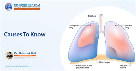 Respiratory Conditions That Lead To A Collapsed Lung