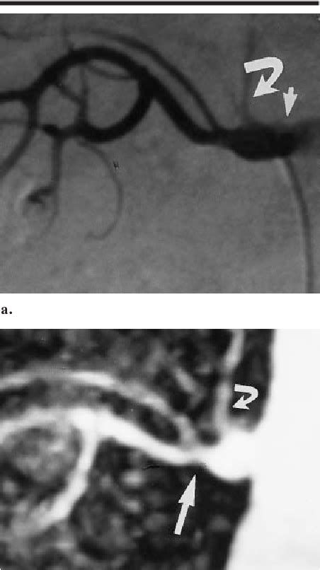 Figure 1 From Renal Artery Stenosis Evaluation With Conventional