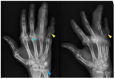 Radiographic Findings of Inflammatory Arthritis and Mimics in the Hands