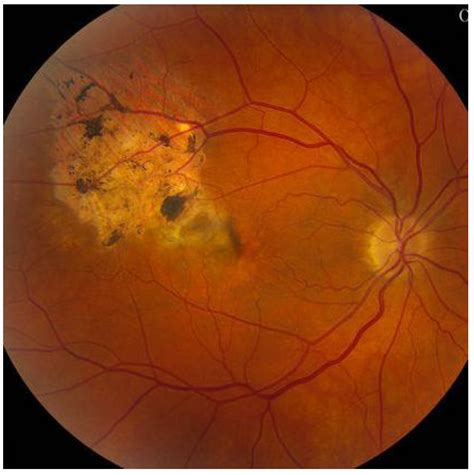 Choroidal Melanoma Fluorescein Angiography