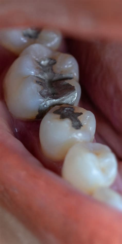 ¿cómo Se Hace Un Empaste Dental Clínica Kranion