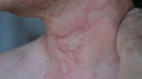 Skin Texture Suffering Allergy Symptom On Neck Stock Image Image Of