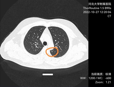 刘懿博士说肺癌（四七二七）33岁小伙体检出叶裂间6mm肺磨玻璃结节 微医（挂号网）