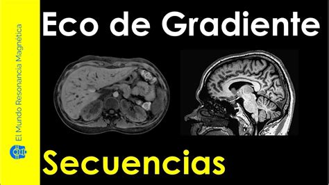 Vídeo 23 Secuencias Eco de Gradiente Resonancia Magnética y su