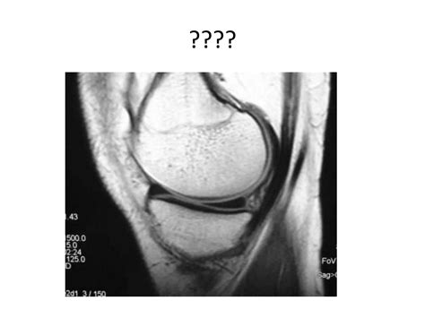 MRI protocol of Knee | PPT