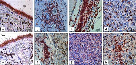 Immunoexpression In Uveal Melanoma Um Tissue Samples With And Without