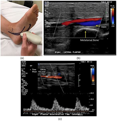 Peroneal Artery Ultrasound