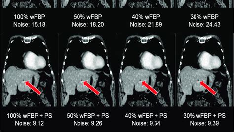 Image Quality Aspects In The Setting Of A Hepatic Melanoma Metastasis