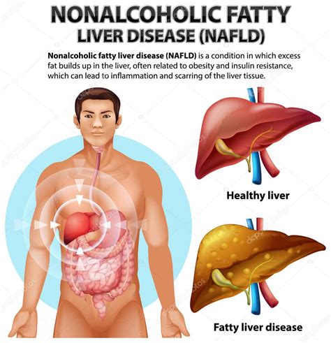Enfermedad Hepática Grasa No Alcohólica Ilustración 2023