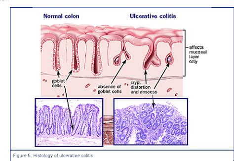 Figure 5 From [ulcerative Colitis Introduction] Semantic Scholar