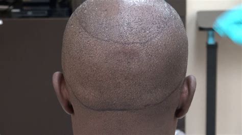 Black African Fue Curly Hair Transplant Minimal Scar Surgery Doctor Specialist Surgeon Dr Diep