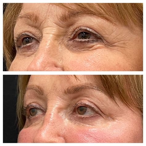 Non Surgical Eye Lift Exilis Ultra Rejuve Medspa Newcastle