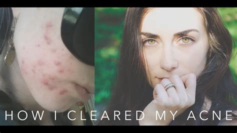 How I Cleared My Acne After 10 Years Youtube